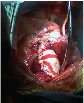 Cuadro i. Etiología de la enfermedad aneurismática  de la aorta ascendente