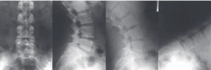 figura 2. Radiografías anteroposterior, lateral, en extensión y flexión,  a los cuatro años de seguimiento.