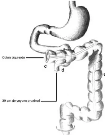 Figura 1.  Niveles de resección intestinal previos.