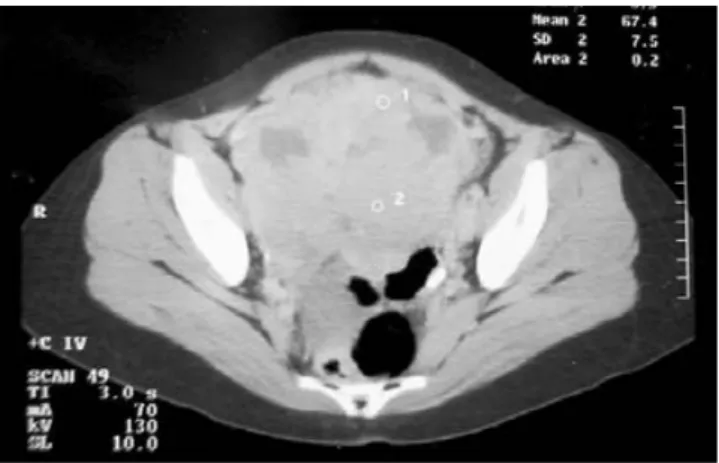Figura 1. Tomografía axial computarizada de abdomen y pel-