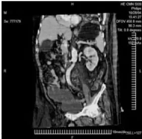 Figura 3.   Imagen en tercera dimensión en corte coronal con imagen ovoidea hipodensa de paredes gruesas, situada adyacente al ciego y que comprime el techo de la vejiga y su pared lateral derecha, sin infiltrarlas, manteniendo interfase entre ellas.