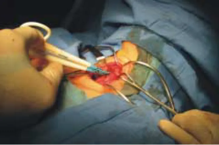 Figura 1. Sellado de arteria tiroidea inferior. Figura 3. Resección de pieza quirúrgica a nivel de istmo.Figura 2