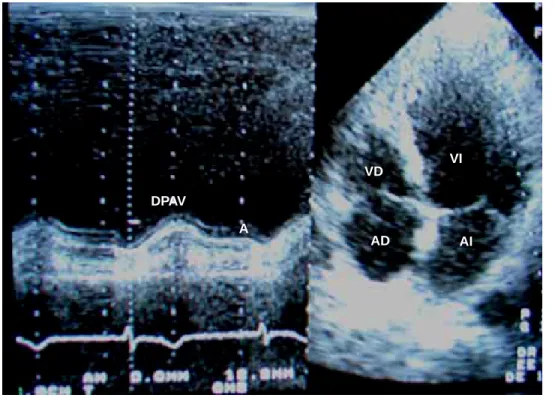 Figura 1. Evaluación del DPAV