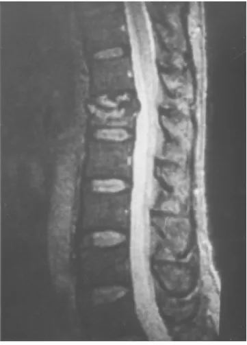 Figura 2. Rx A.P. de columna vertebral con instrumentación