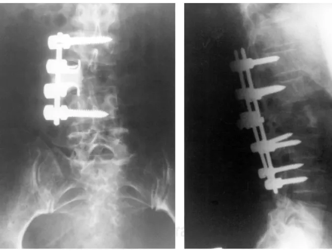 Figura 4. Rx lateral de la columna vertebral con metástasis