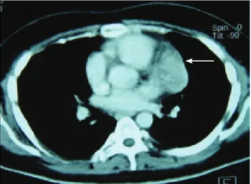 figura 1. En la tomografía de tórax, corte axial, se observa una opa-