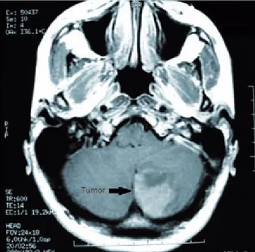 figura 1. Con la resonancia magnética se observa un tumor en el 