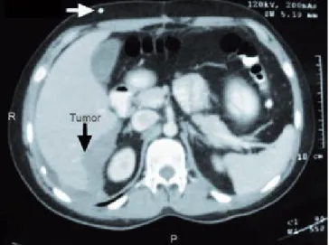 figura 6. Pieza quirúrgica, residual tumoral del espacio rectovesical.figura  4.  Importante  disminución  del  volumen  tumoral  por  efecto 