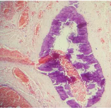 Figura 1. Biopsia de pene. Arteriola con calcificación extensa