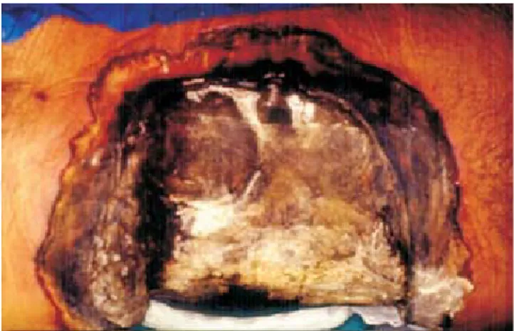Figura 1. Herida abdominal 20 cm de diámetro (primer día