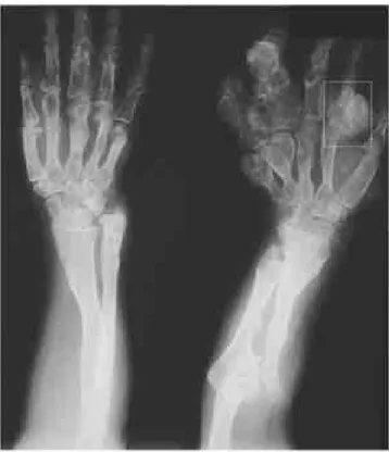 Figura 1.  Lesión en falange proximal de segundo dedo de mano izquierda compatible con condrosarcoma.