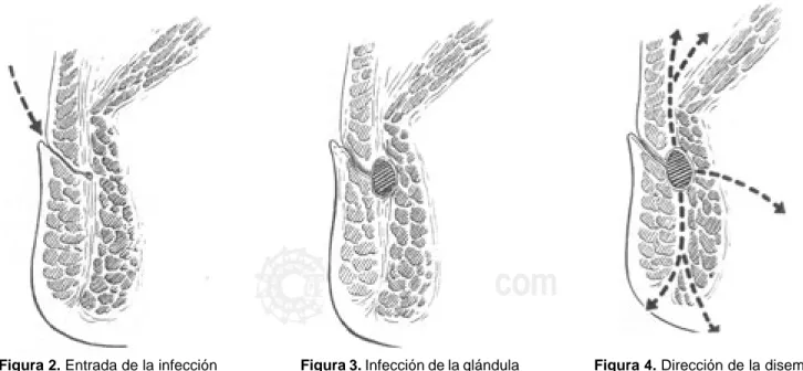 Figura 3. Infección de la glándula y formación de absceso.