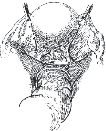 Figura 1. Apertura del peritoneo parietal pélvico.