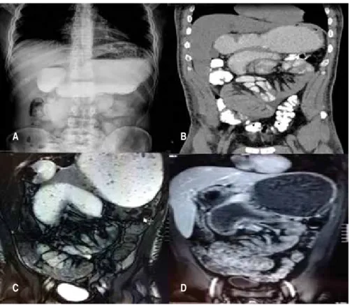 Figura 1: (A) Tránsito intestinal con medio 