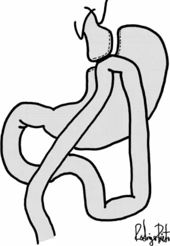 Fig. 5. Anastomosis gastroyeyunal.