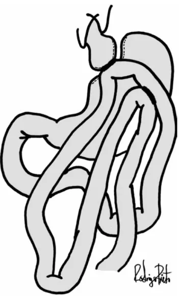 Fig. 6. Yeyuno-yeyuno anastomosis.