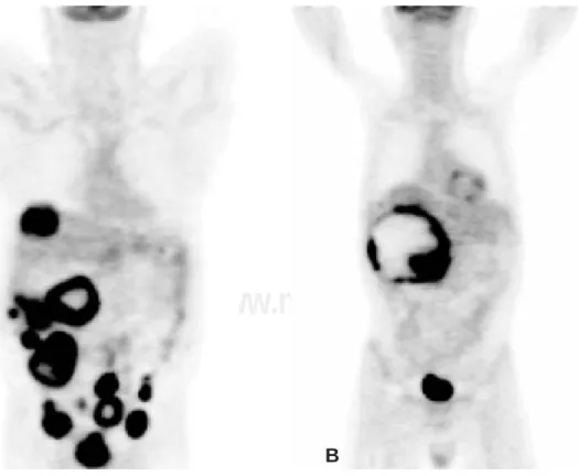 Fig. 3. A. Paciente con múltiples metástasis peritoneales y  hepáti-cas, medido por PET