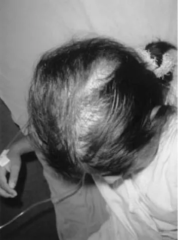 Fig. 1. Zona de alopecia.