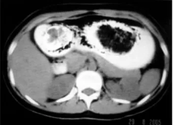 Fig. 3. Tomografía axial computarizada de abdomen.