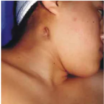 Fig. 2. Fístula.