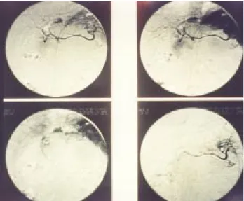 Fig. 2. Angiografía selectiva: se observa trombosis de la vena esplénica.