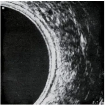 Fig. 1.  Detalle de las diferentes capas de la pared rectal de-