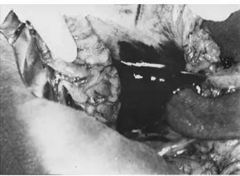 Fig. 3. Lesión del conducto pancreático.