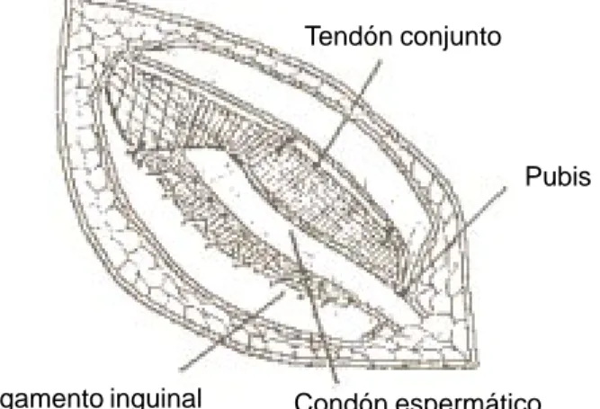 Fig. 1. Fijación de la malla (8x15 cm), iniciandola entre tendón conjunto y tubérculo púbico, y a lo largo del ligamento inguinal.