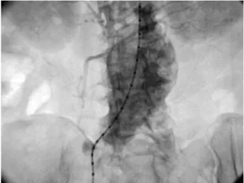 Fig. 1. Aneurisma de aorta abdominal infrarenal.