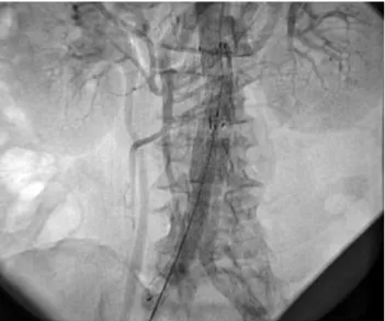 Fig.  3.  Dilatación  con  balón,  utilizado  para  tratamiento  de  endofuga tipo I.