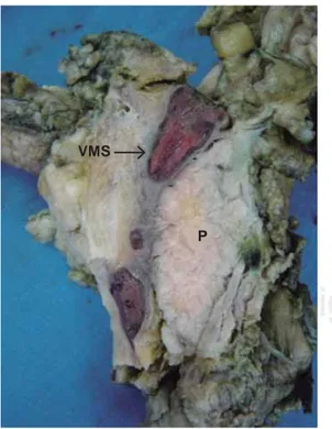 Fig. 5. Hallazgos de autopsia. Trombo en la vena mesentérica  superior (VMS) en su paso posterior al páncreas (P).