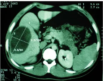 Fig. 3. TAC de abdomen de ingreso. Hematoma parenquima- parenquima-toso hepático.