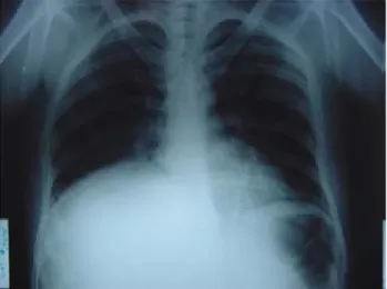 Fig. 3. Radiografía de tórax: elevación del hemidiafragma.