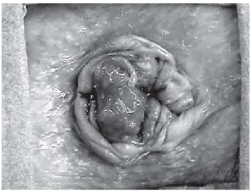 Fig. 8. Prolapso hemorroidal grado IV.