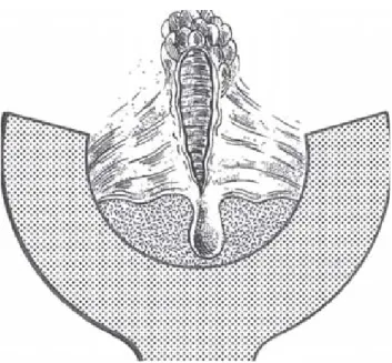 Fig. 1. Fisura anal crónica (tríada de Brodie): 1) papila anal hipertrófica, 2) úlcera y 3) colgajo cutáneo o “hemorroide  cen-tinela”.