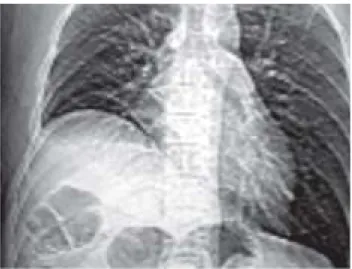 Fig. 1. Nótese la elevación marcada del hemidiafragma dere- dere-cho hasta el 7 o  espacio intercostal.