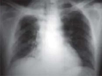 Fig. 6. Control radiográfico postoperatorio, donde se nota la corrección de la elevación diafragmática.