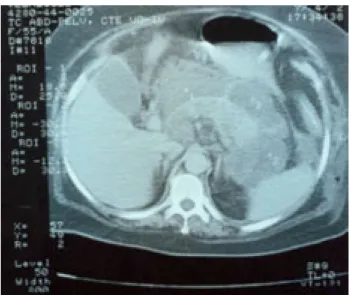 Fig. 1. Tomografía computada de abdomen.