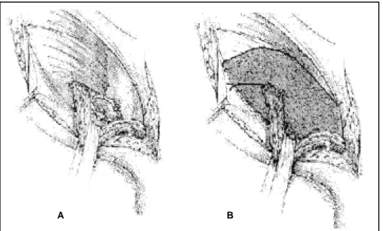 Fig. 1. Técnica “De Cisneros” A.-Paso 1; colocación del “plug” en el defecto herniario