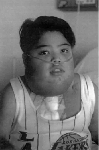 Fig. 3. Edema cefálico extremo (con autorización del paciente).