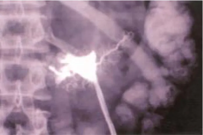 Fig. 3. Fistulograma a través del catéter donde se demuestra comunicación a conducto pancreático principal.