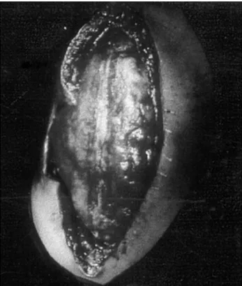 Fig. 5. Herida limpia, sin malla (preparada para colocación de injerto de piel).