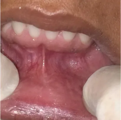Fig. 2. Mucosa del labio y surco vestibular después de la aplicación del láser