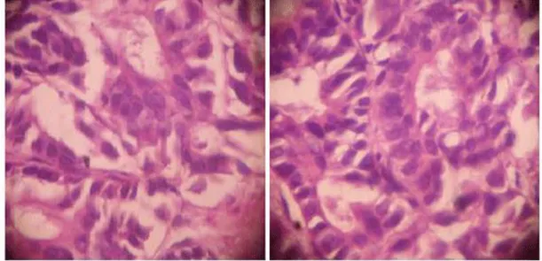 Fig. 1. Imagen microscópica de adenocarcinoma neuroendocrino de próstata 
