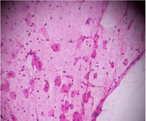 Fig. 2. BAAF del bazo con células de Gaucher mostrando el citoplasma  