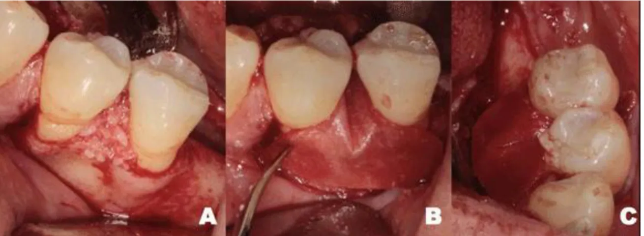 Fig. 2 A) Colocación del aloinjerto óseo (FDBA) B) adaptación de la membrana reabsorbible de  colágeno por vestibular y C) adaptación por lingual 