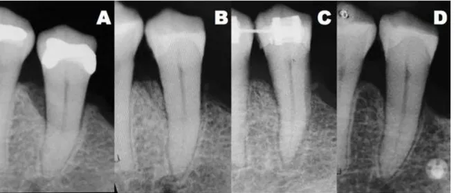 Fig. 3 A) Radiografía preoperatoria B) evidencia radiográfica de llenado del defecto a los 2 meses  C) formación ósea a los 4 meses D) radiografía de control a los 12 meses 