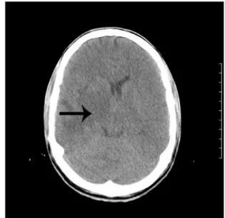 Fig. 1. TAC de cráneo  simple.  Edema cerebral   difuso en región temporoparietal derecha 