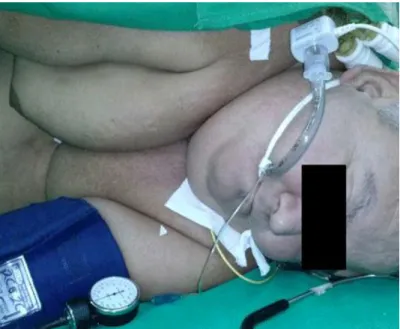 Fig. 3. Intubación del paciente en decúbito lateral izquierdo 