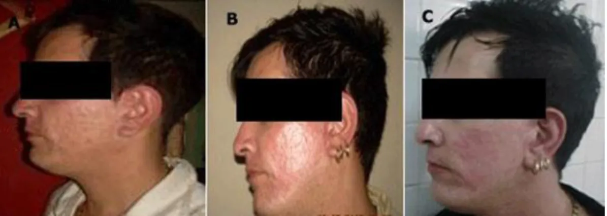 Fig. 1. A) Preoperatorio, B) Postoperatorio (21 días), C) Postoperatorio (3 meses)  Caso 2 